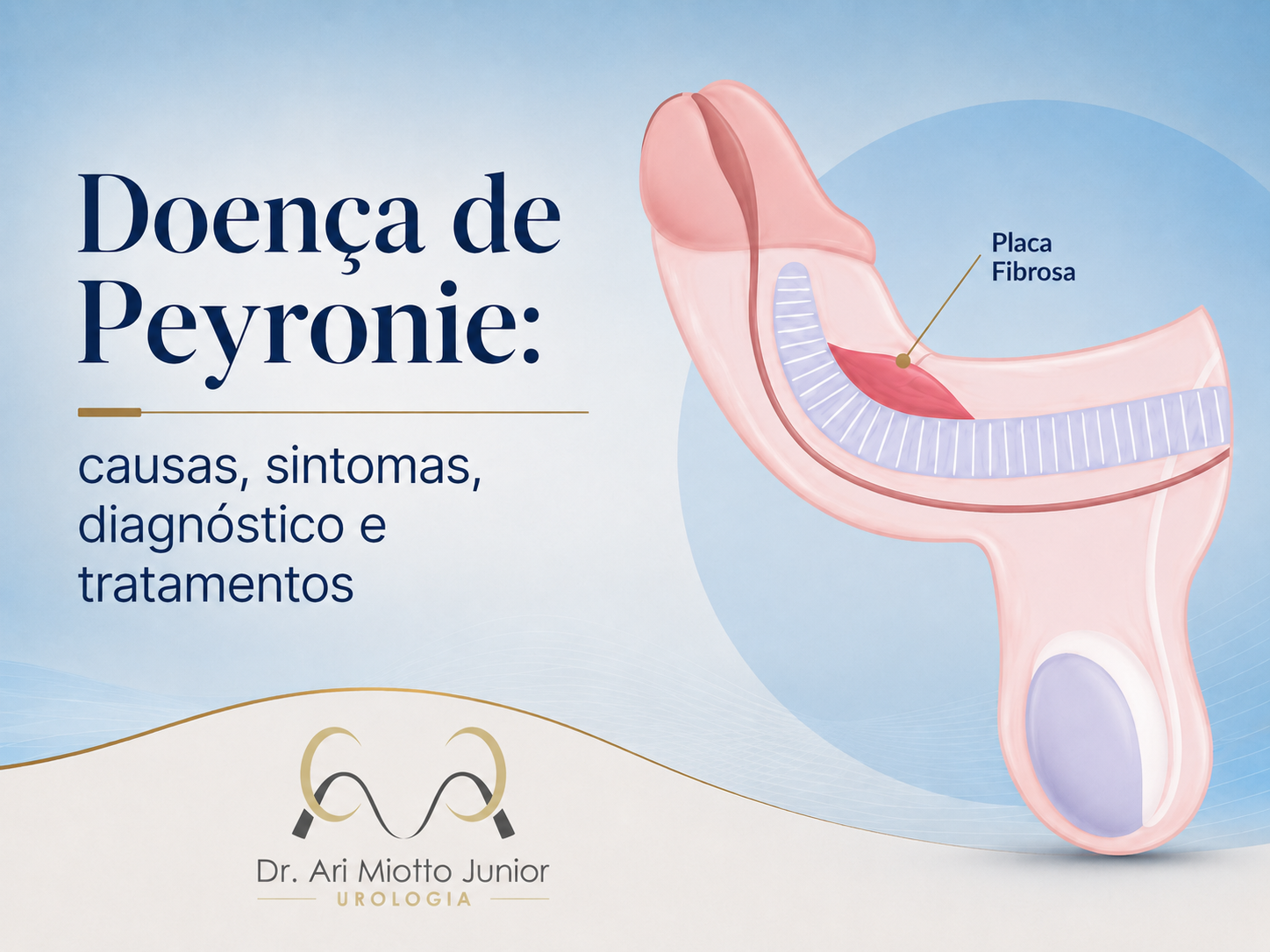 Doença de Peyronie causas, sintomas, diagnóstico e tratamentos